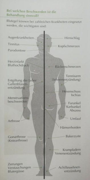 Indikationen Blutegel